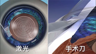 白內障手術